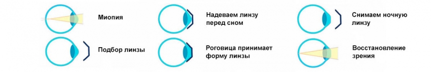 ночные линзы в клинике Glazgo