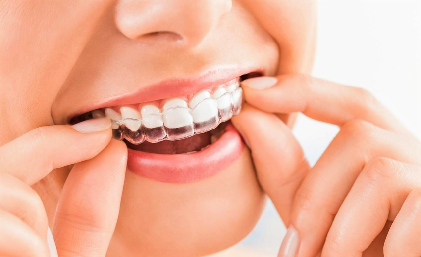 елайнери Invisalign