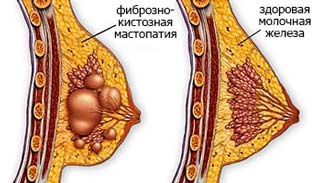 Лечение фиброзно кистозной мастопатии: виды заболевания, причины возникновения