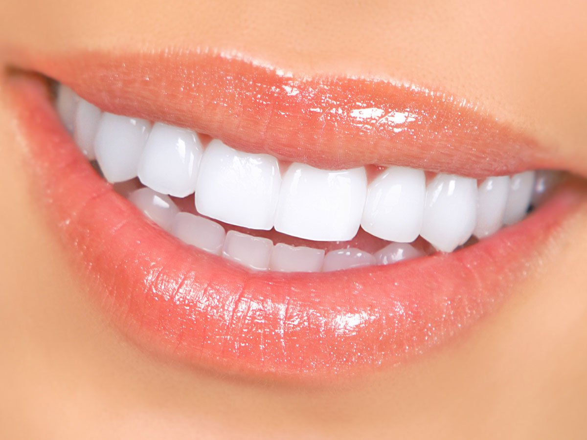 veneers