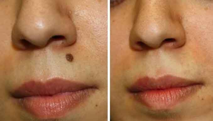 get-rid-of-moles-on-skin