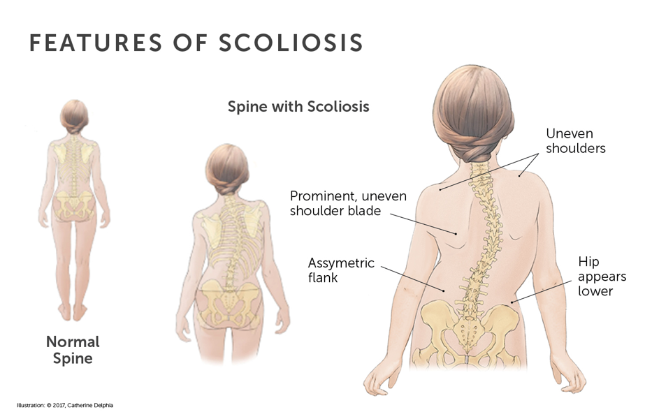 scoliosis-treatment