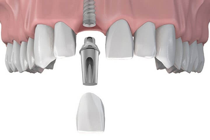 implant2