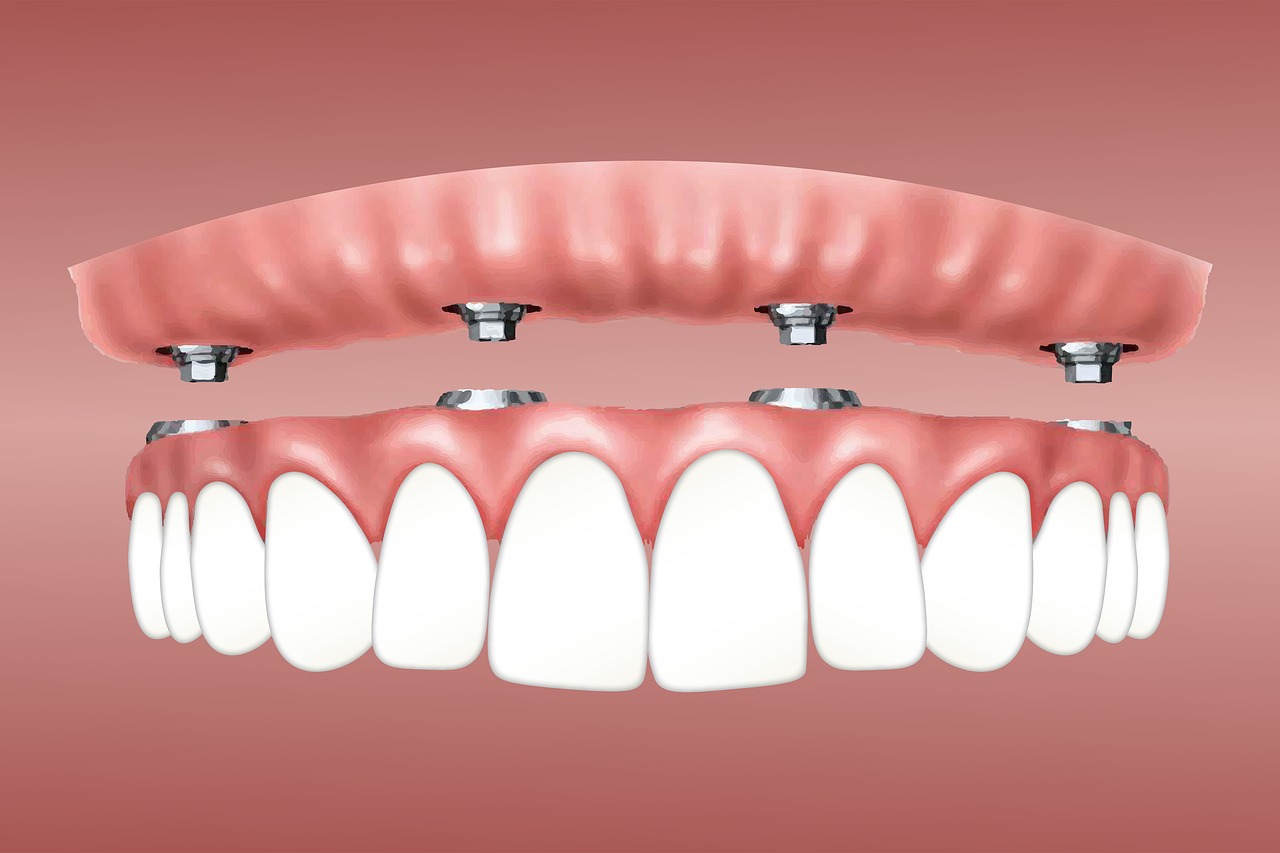 overdenture-3597628_1280