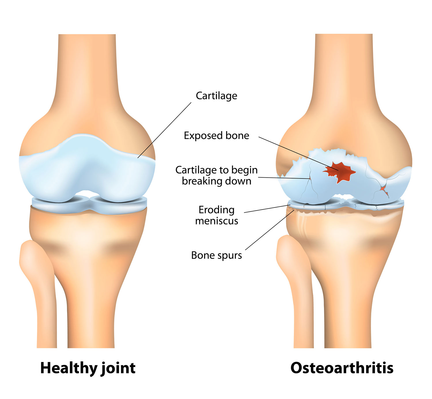 osteoarthritis_1500x1386