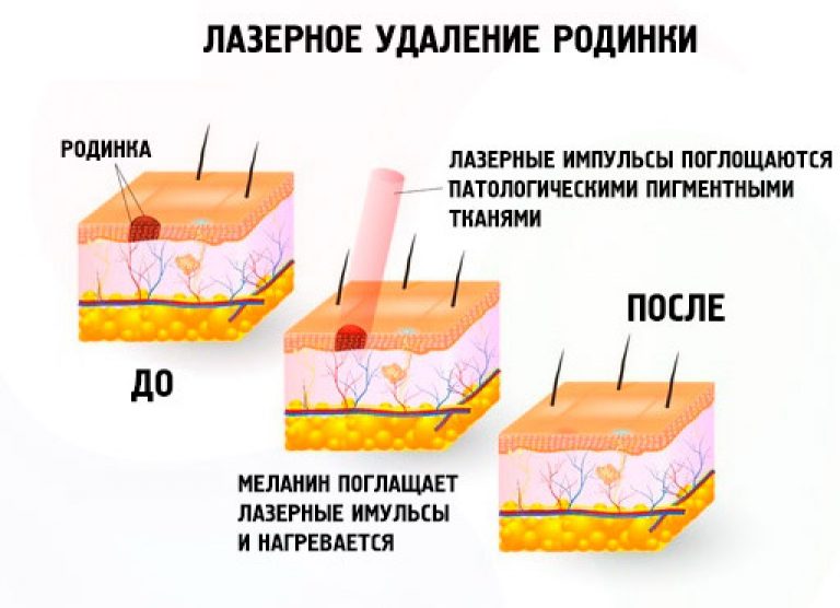 Лазерное удаление родинок, папиллом и бородавок в Харькове