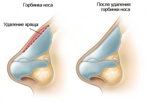 Відповіді на поширені запитання, які задають пластичному хірургу