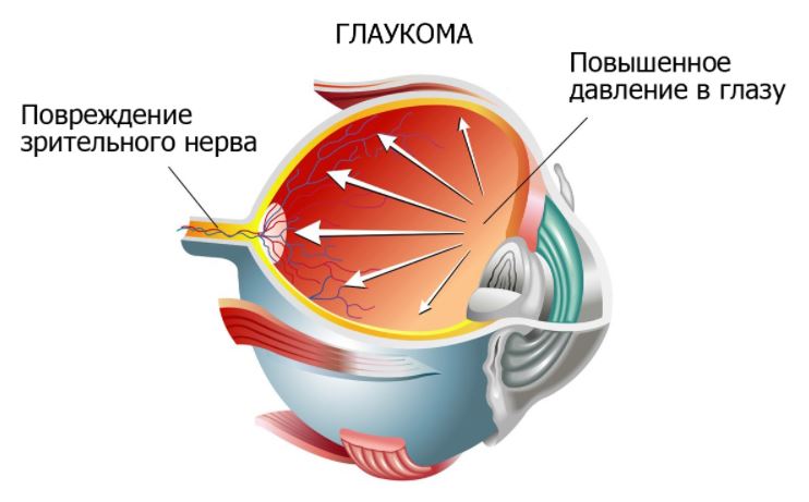 Информация о глаукоме, которую следует знать каждому