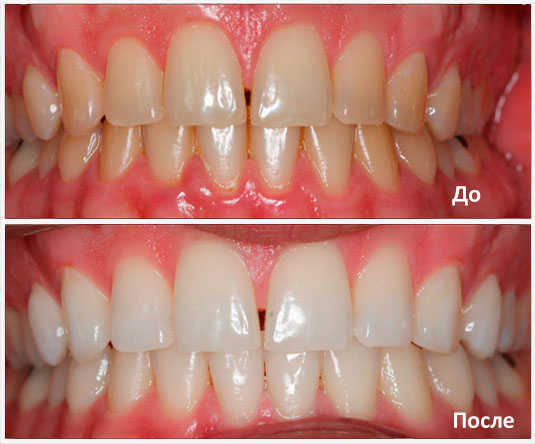 Magic Smile: почему стоит отбеливать зубы по этой технологии?