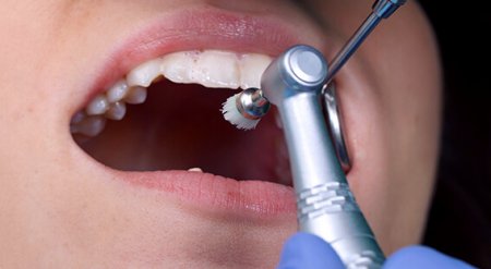 1576669557_ftorirovanie-zubov